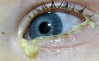 Гнойный конъюнктивит у детей: чем и как лечить глаза