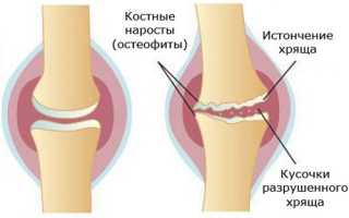 Симптоматика и лечение пателлофеморального артроза коленного сустава