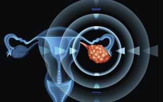 Опухоли яичников: чего стоит опасаться?