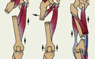 Методы устранения перелома диафиза бедренной кости