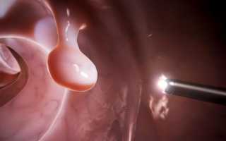 Удаление полипов в кишечнике: виды операций, послеоперационный период