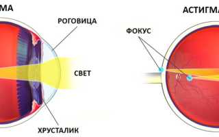 Лазерная коррекция астигматизма: лечение зрения через операцию