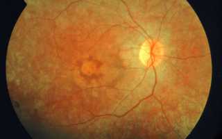 Ретинит глаза: что это такое, симптомы и лечение