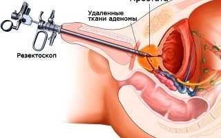 Диагностика и лечение аденомы простаты