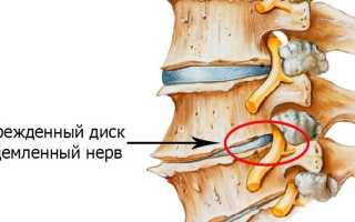 Когда необходима операция по удалению грыжи поясничного отдела позвоночника