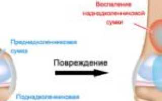 Перечень препаратов для уколов в коленный сустав при артрозе