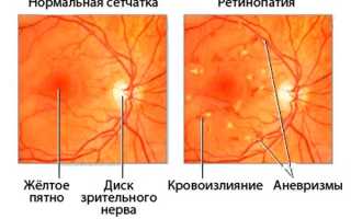 Гипертоническая ретинопатия: симптомы и лечение