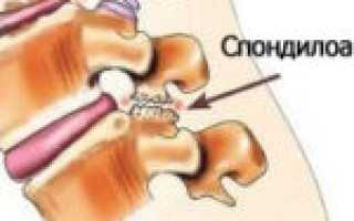 Симптомы и методы лечения корешкового синдрома шейного отдела позвоночника