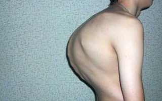 Степени прогрессирования и методы устранения гиперкифоза грудного отдела позвоночника