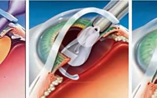 Замена хрусталика глаза при катаракте: что нужно знать про операцию?