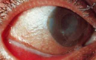 Синдром сухого глаза: причины и как избавиться