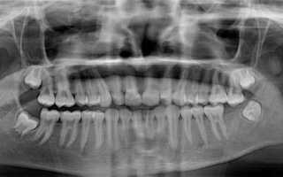 Клиническая картина остеонекроза челюсти и причины возникновения патологии