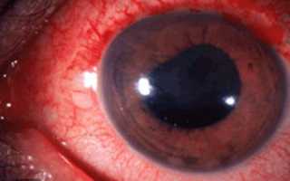 Герпес на глазу и веке: симптомы, лечение глазными каплями и мазями