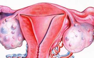 Доброкачественные опухоли яичников: что нужно знать женщине