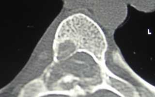 Причины возникновения у позвоночника костных опухолей остеобластома