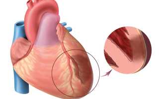 Как самостоятельно определить инфаркт миокарда?