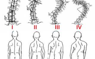 Степени левостороннего сколиоза и методы его лечения