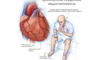 Сердечная недостаточность: описание, признаки, причины и лечение болезни