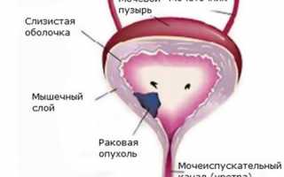 Опухоли мочевого пузыря: виды, причины, диагностика и лечение