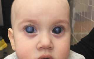 Врожденная глаукома: лечение и признаки у новорожденных