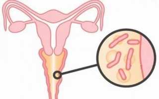 Бактериальный вагиноз: симптомы и лечение
