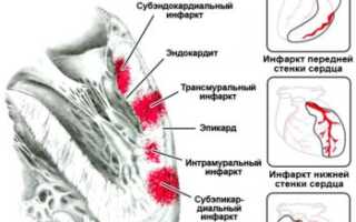 Виды инфаркта — типичные и атипичные формы