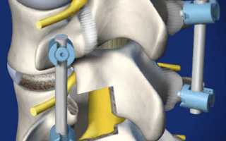 Как проводится спондилодез поясничного отдела позвоночника
