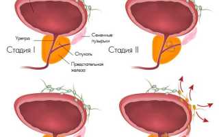 Стадии рака простаты