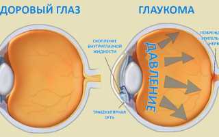 Норма глазного давления при глаукоме: как снизить высокие показатели