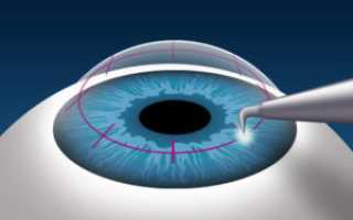 Дистрофия роговицы глаза: виды и методы лечения
