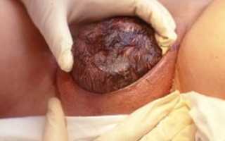 Причины и последствия родовой травмы шейного отдела позвоночника у новорожденных