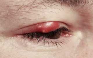 Аллергический блефарит: причины, симптомы и лечение