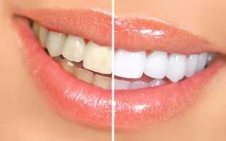 Почему появляется пародонтоз: популярные причины по опыту стоматолога