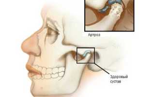 Симптомы и лечение артроза челюстно лицевого сустава