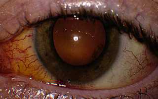 Хориоретинит глаз: симптомы и лечение