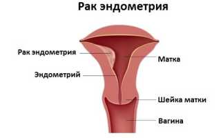 Рак тела матки (рак эндометрия)
