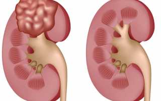 Киста левой почки: насколько опасно заболевание