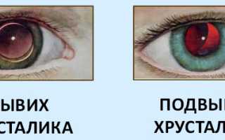 Вывих хрусталика глаза у человека: причины, симптомы и лечение