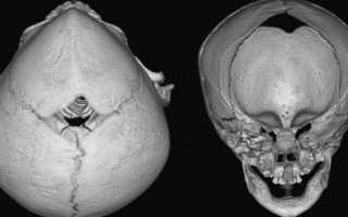 Как влияет на развитие ребенка метопический синостоз
