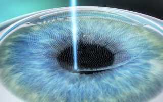 Что делать при тонкой роговице глаза: причины и коррекция зрения