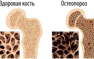 Опасность развития остеопороза у детей и способы его лечения