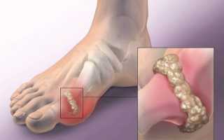 Основные симптомы артрита пальцев ног, а также методы эффективного лечения
