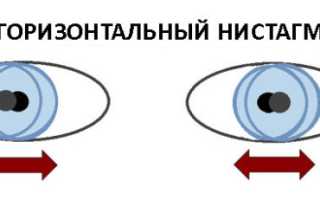 Горизонтальный нистагм: что это такое, причины, симптомы и лечение