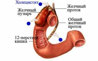 Болезни желчного пузыря: симптомы и лечение