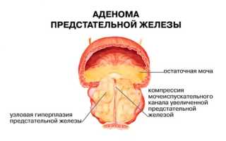 Симптомы аденомы простаты