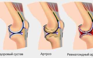 Причины вызывающие заболевание ревматоидного артрита у детей