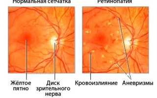 Ретинопатия сетчатки глаза: что это такое, симптомы и лечение