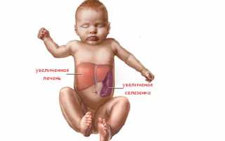 Причины, симптомы гепатомегалии и способы борьбы с ней