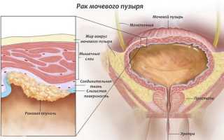 Рак мочевого пузыря в вопросах и ответах