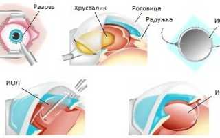 Экстракция катаракты: интракапсулярная и экстракапсулярная (с ИОЛ)